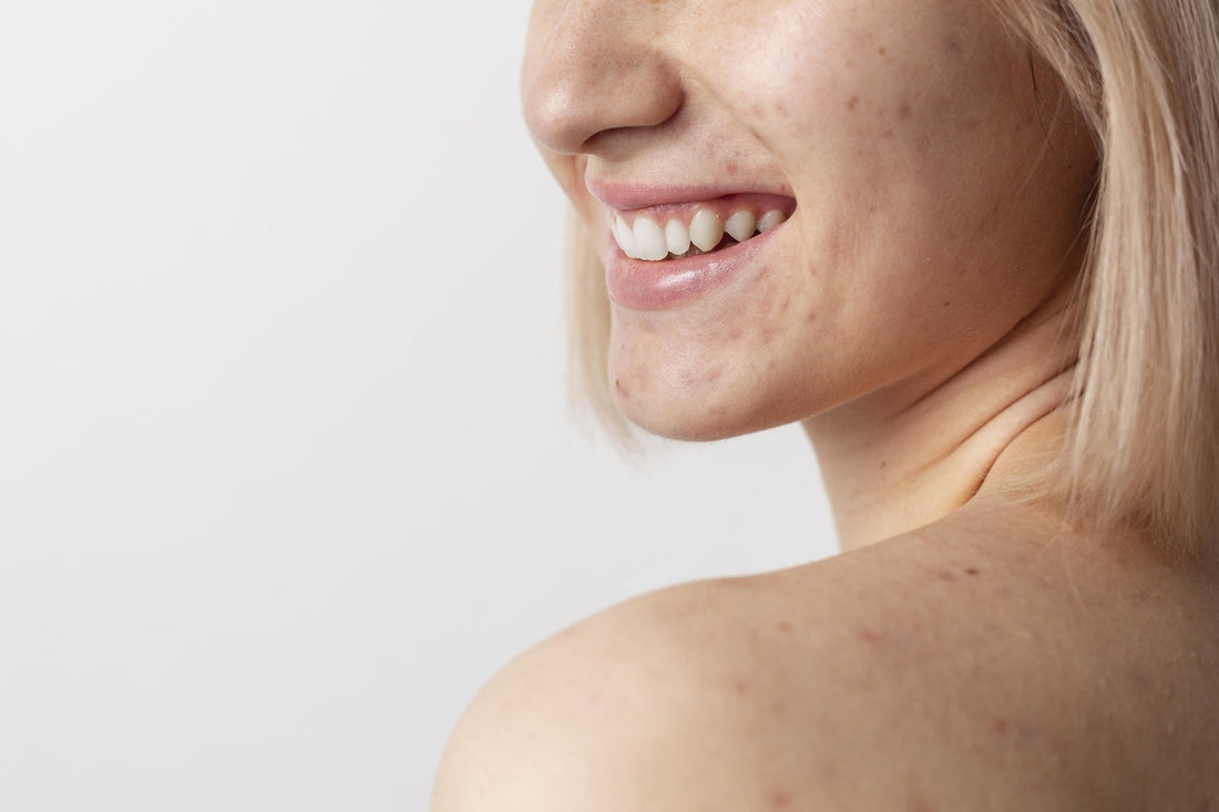 Apple Cider Vinegar for Skin Health: How It Can Improve Acne and Support Clear Skin